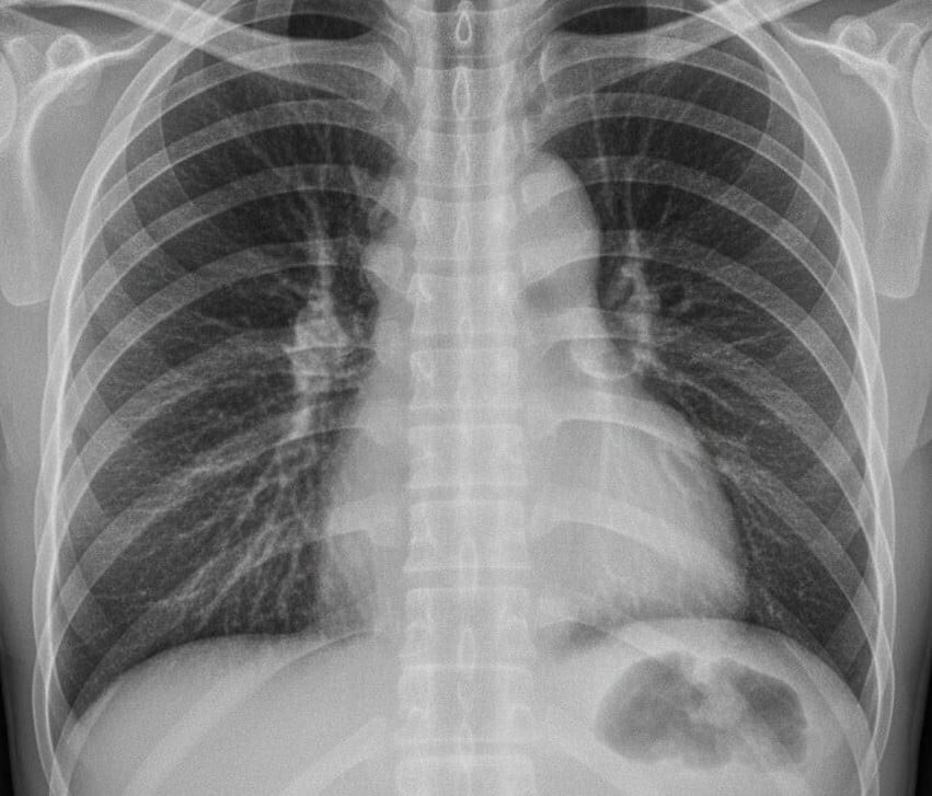 Chest X-ray