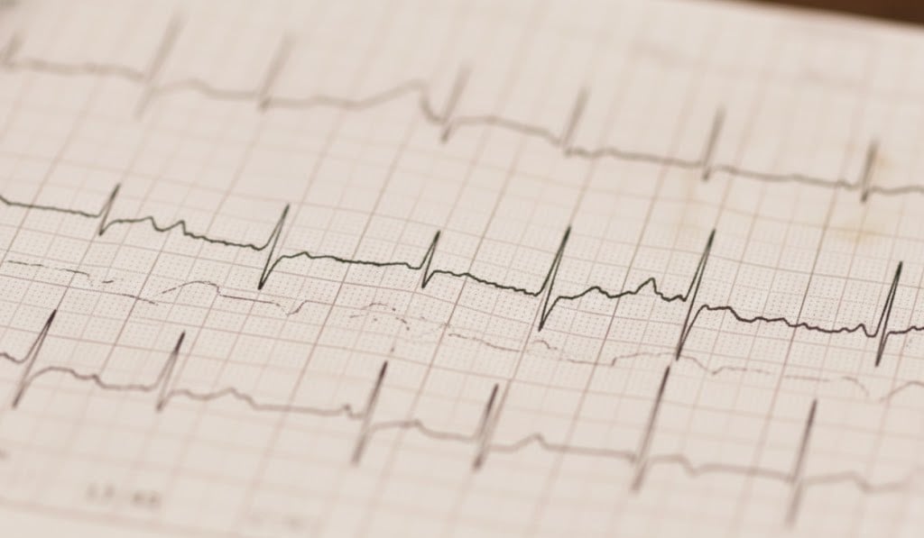 Result graph from Holter monitor