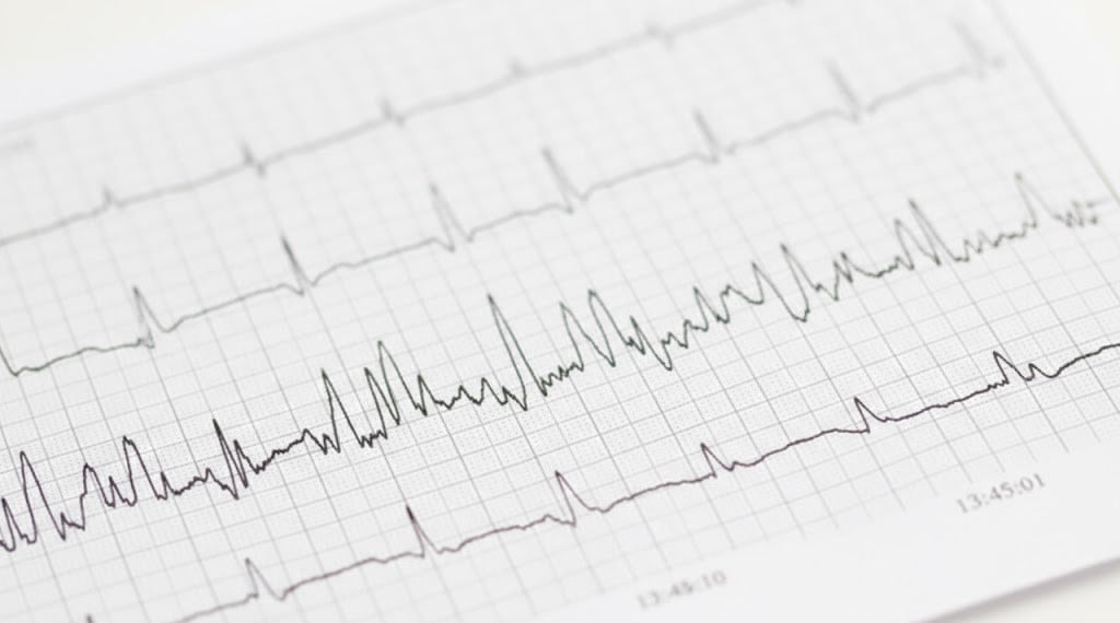 Result graph from Holter monitor