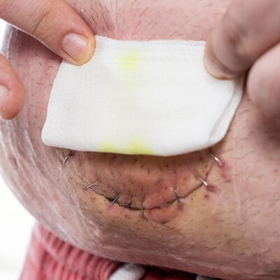 Stomach stitches removal