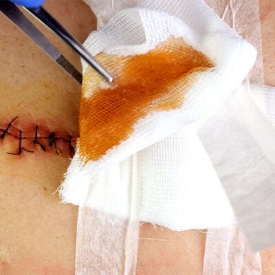 Skin stitches removal