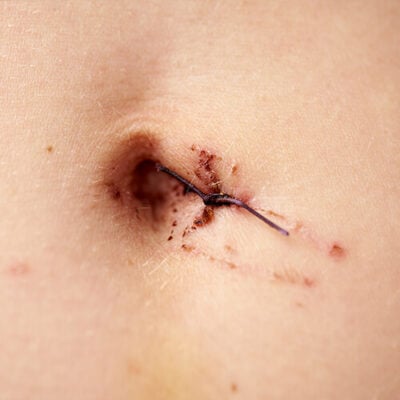 Stomach stitches removal