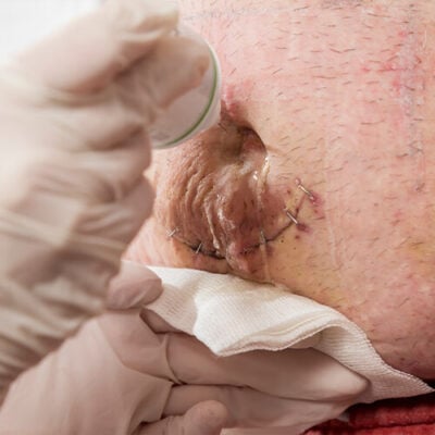 Stomach stitches removal