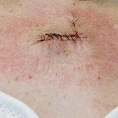 Skin stitches removal
