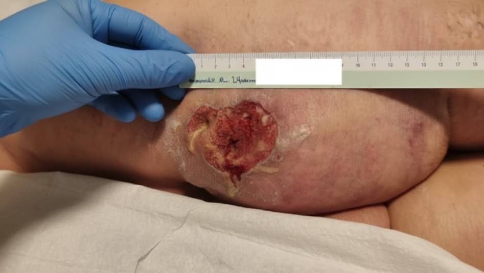 Second stage bedsore