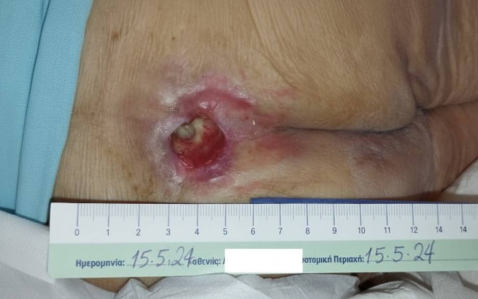 Fourth stage bedsore