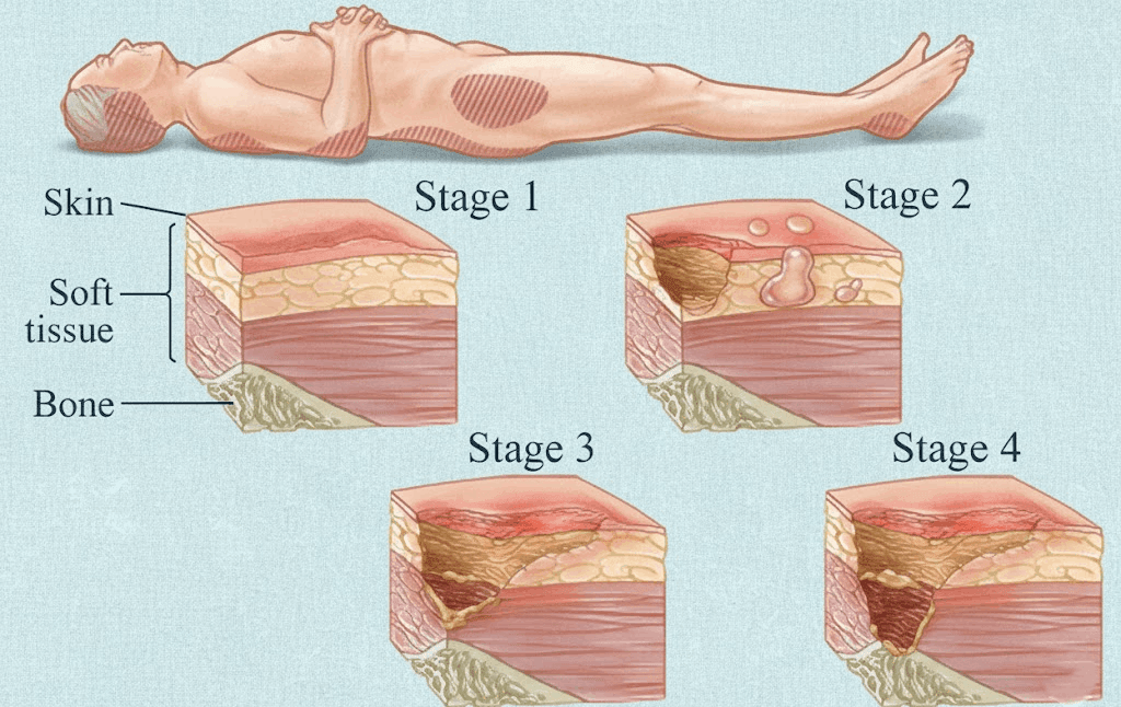 Stages of bedsores illustrated
