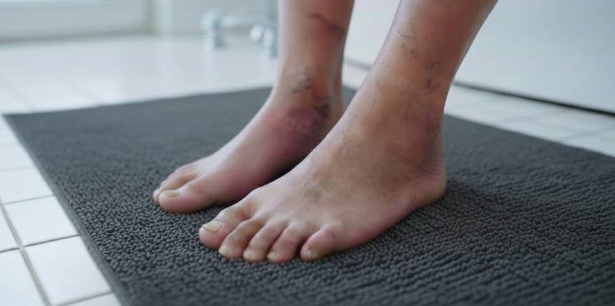 Διαβητικό Πόδι